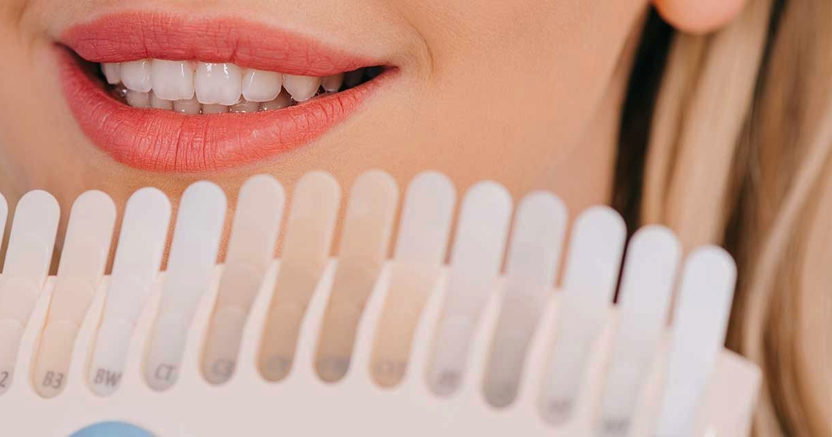 Teeth Whitening In Rancho San Diego Simhairy Dental